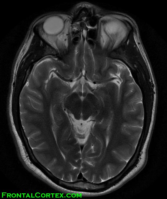 MRI T2 MCA ACA normal