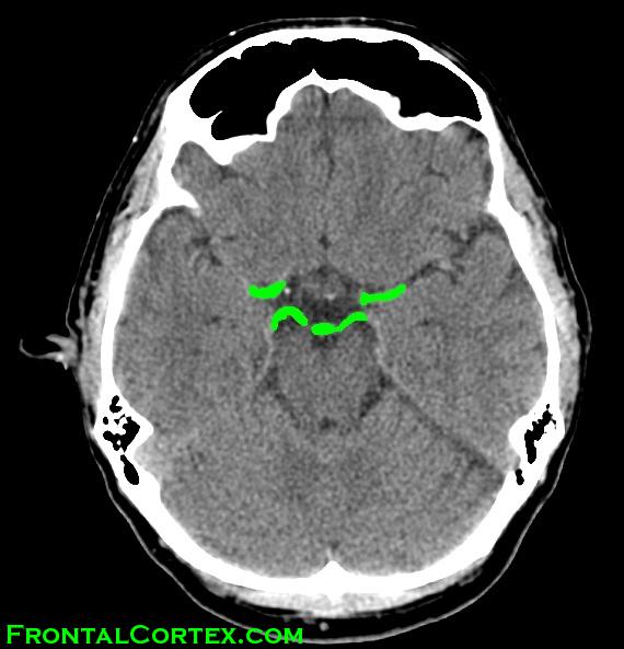 CT Circle of Willis highlighted