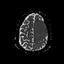 MRI ADC meningioma