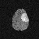 MRI DWI meningioma