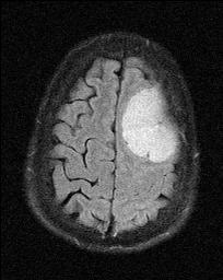 MRI FLAIR meningioma