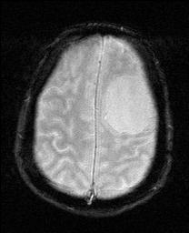 MRI GRE left frontal meningioma