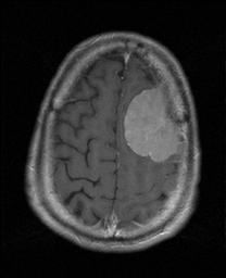 MRI T1 Gad meningioma