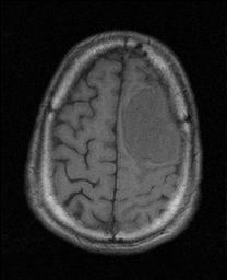 MRI T1 meningioma