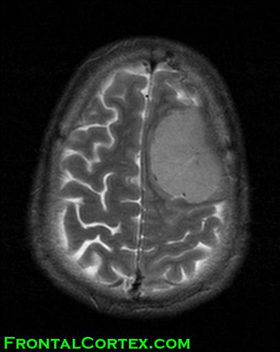 MRI T2 meningioma