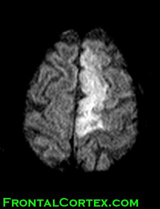 MRI DWI left ACA stroke