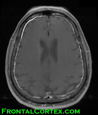 MRI w GAD - enhancing meninges