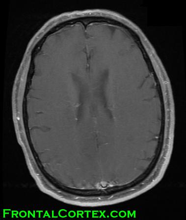 MRI - normal meninges for comparison