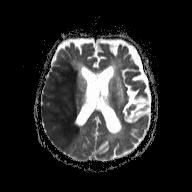 MRI ADC acute right MCA stroke
