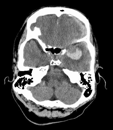 CT subarachnoid hemorrhage