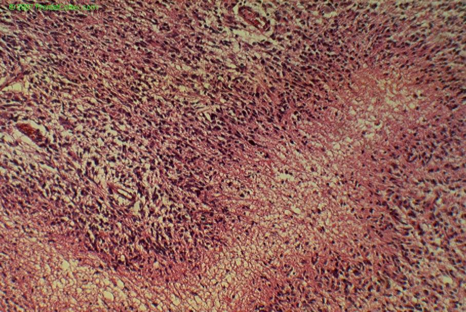 Glioblastoma multiforme, pseudopallisading Necrosis, H&E stain x 200