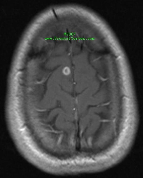 Ring-enhancing Lesion MRI