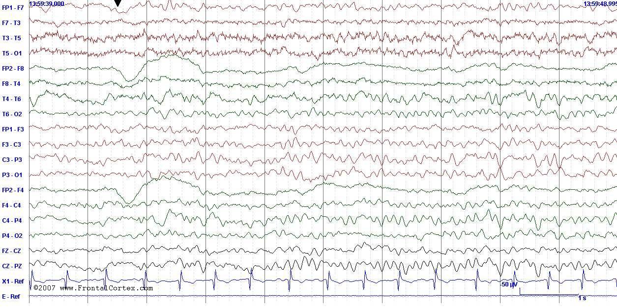 EEG normal tachycardia