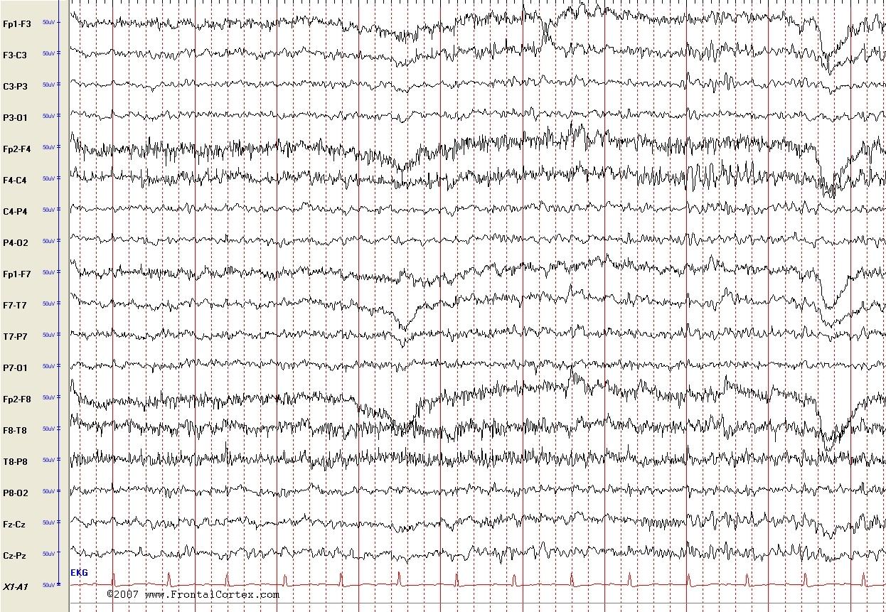 EEG normal with EKG artifact