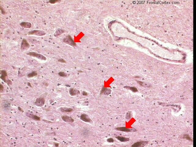 Substantia nigra neuromelanin