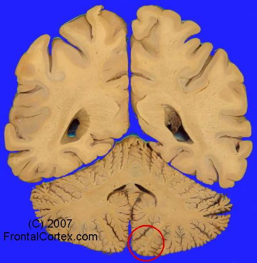 Gross Brain Highlighting Medial