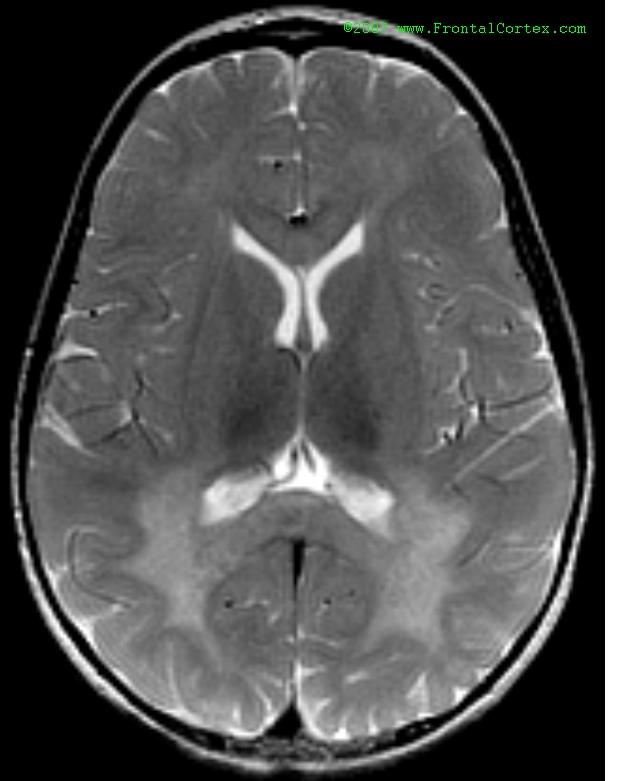 Metachromatic Leukodystrophy MRI
