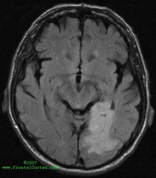 Alexia without agraphia resulting from ischemic stroke