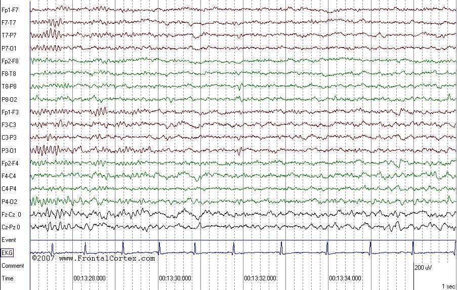 EEG normal sleep