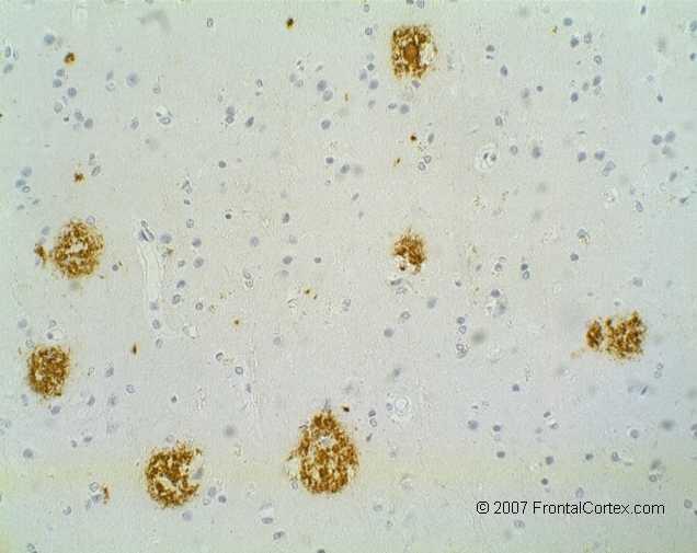 Amyloid Plaques on Immune Staining for Amyloid