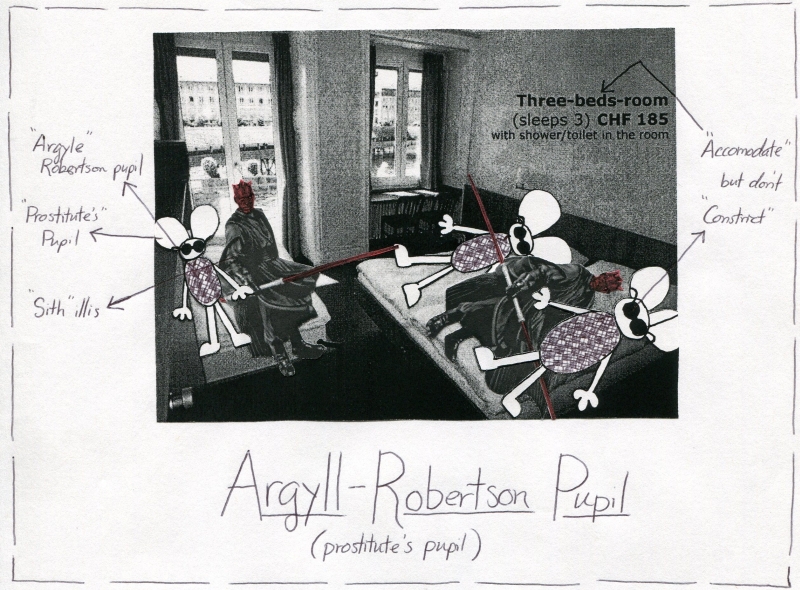 Argyll-Robertson Pupil