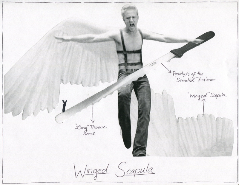Winged Scapula