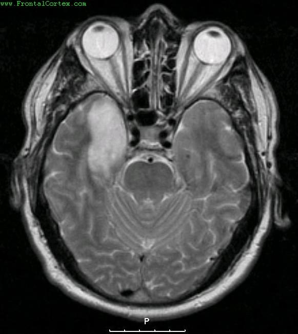 Viral Encephalitis - MRI