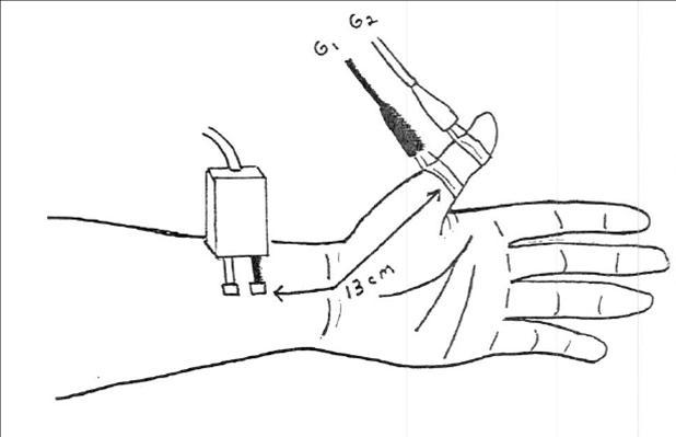 Median Sensory Nerve – thumb (antidromic