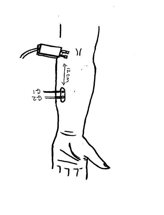 Medial Antebrachial Cutaneous Sensory Nerve – Forearm (antidromic)