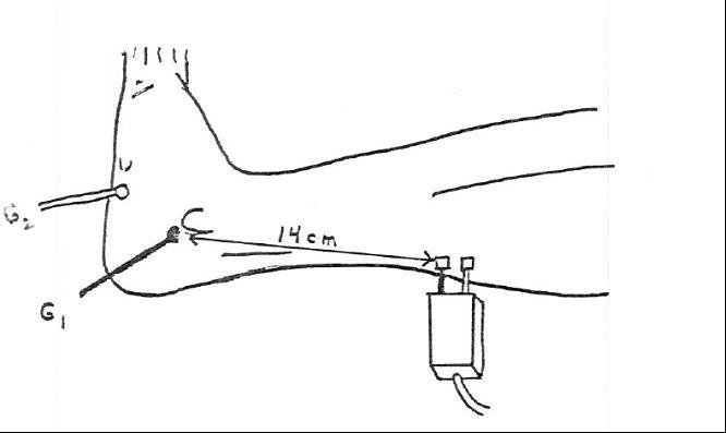 Sural Sensory Nerve - recording behind the Lateral Malleolus (antidromic)