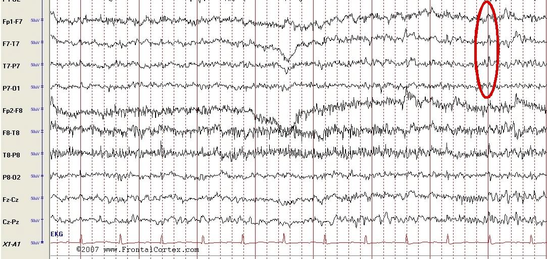 EEG normal with EKG artifact