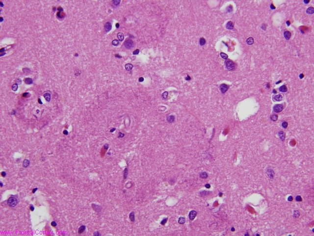  Familial Alzheimer's disease, cotton-wool plaque, H&E stain