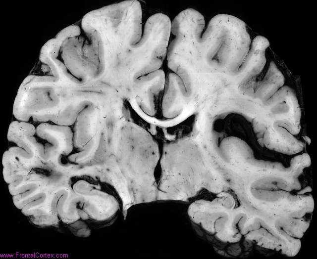 Dilated middle cerebral artery s