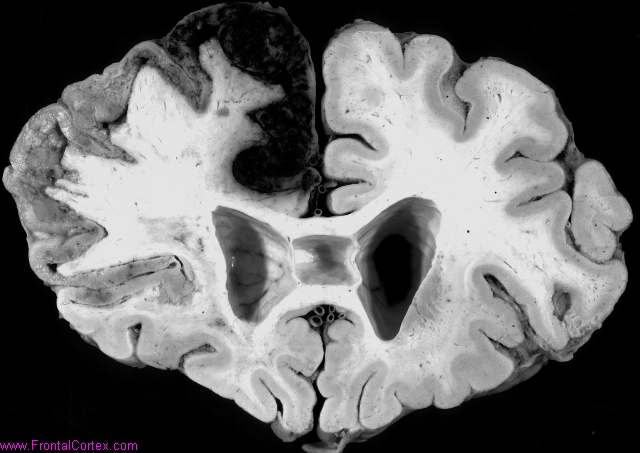 Organizing infarct, middle cereb