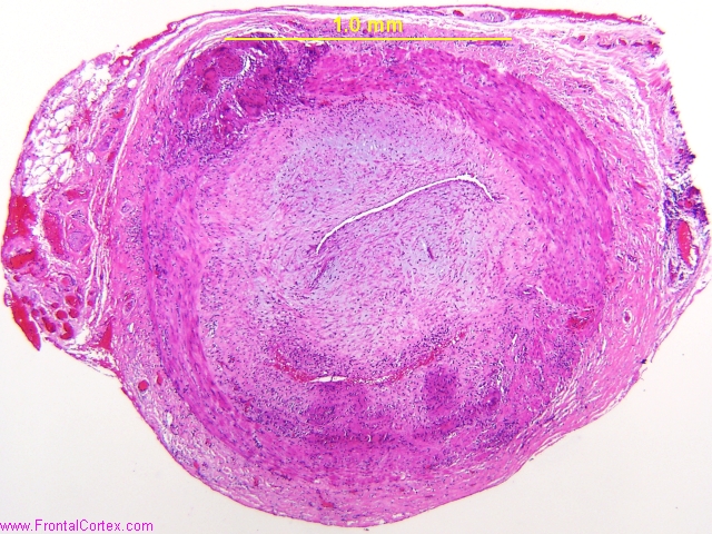 Giant cell arteritis, temporal a