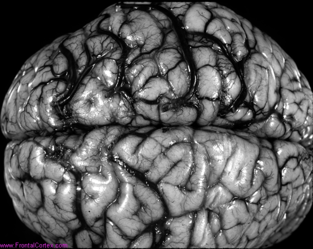 Cortical venous thrombosis in a