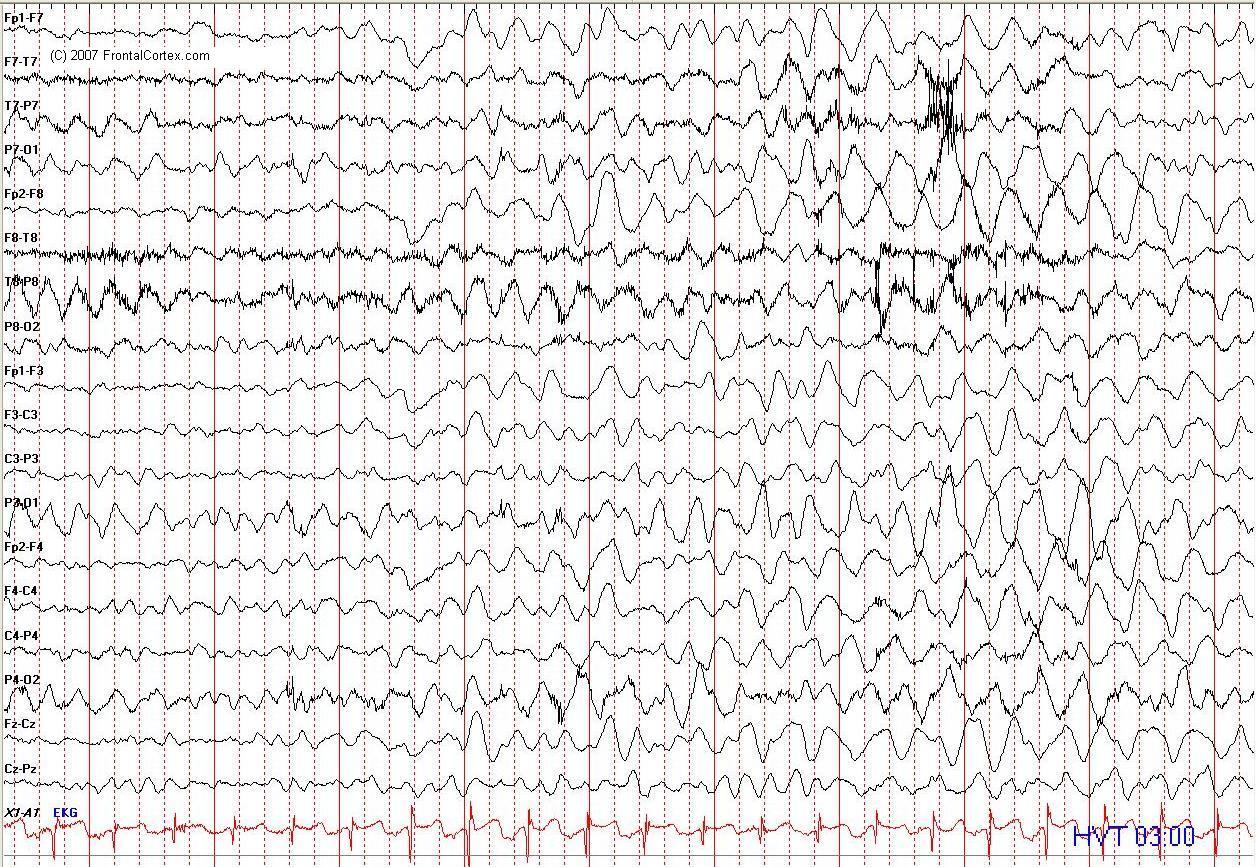 EEG slowing in hyperventilation