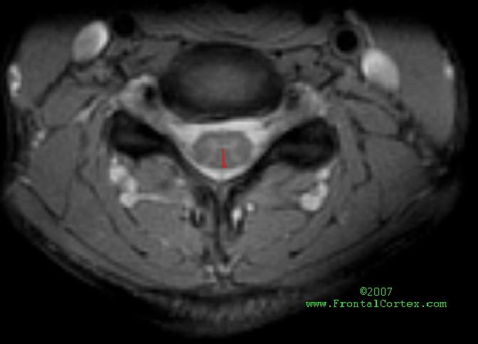 Fasciculus Gracilis C6 MRI