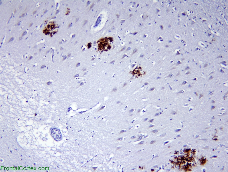 Alzheimer disease, hippocampus, beta amyloid immunohistochemical stain