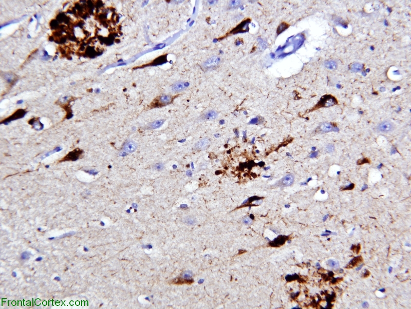 Alzheimer's disease, hippocampus Tau IHC 200x