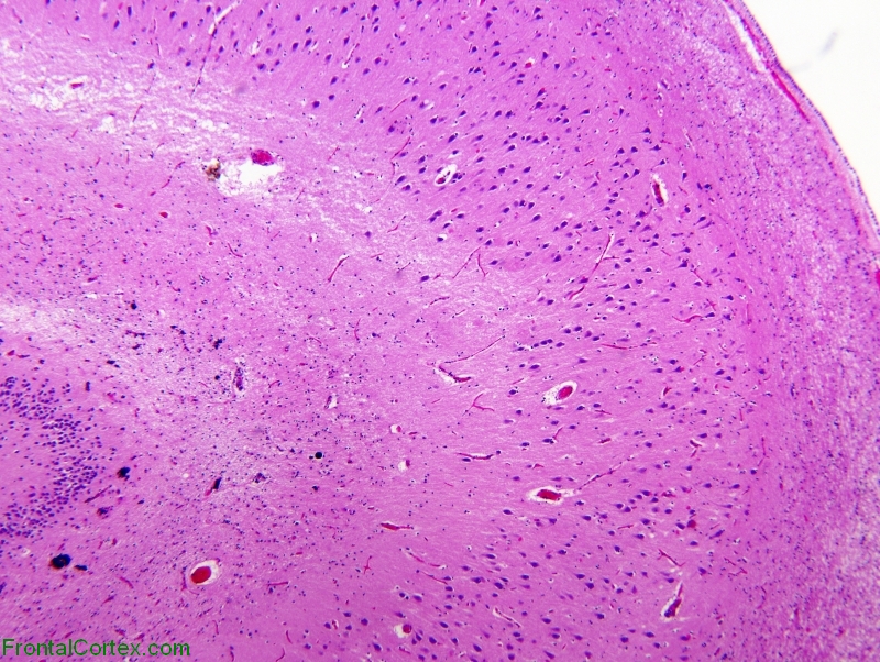 Alzheimer's disease, H&E stained section of hippocampus, low power magnification.