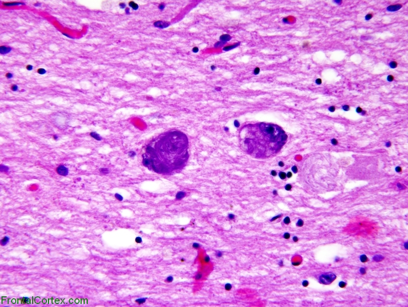 Alzheimer's disease, nucleus basalis of Meynert x 400