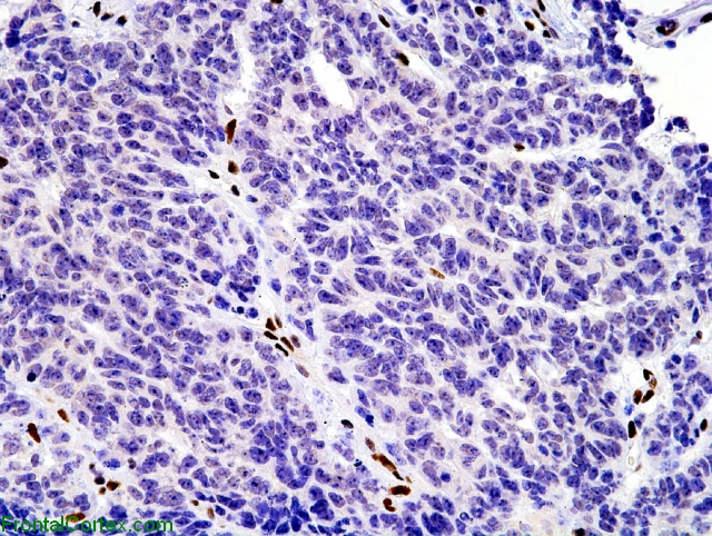 Atypical teratoid/rhabdoid tumor, BAF-47 immunohistochemical staining