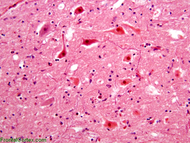 Acute hypotensive brainstem necrosis, hypoglossal nucleus, H&E stain