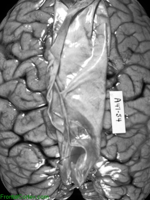 Acute Lead Encephalopathy, Dorsal surface of brain.