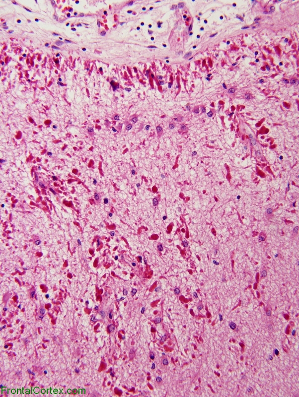 Alexander Disease, H&E stained section of cerebral cortex, 200 X magnification