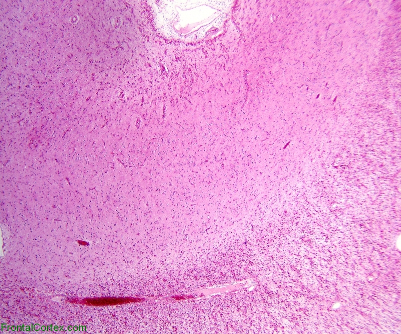 Alexander Disease, cerebral cortex and white matter, H&E stained section, 20X magnification