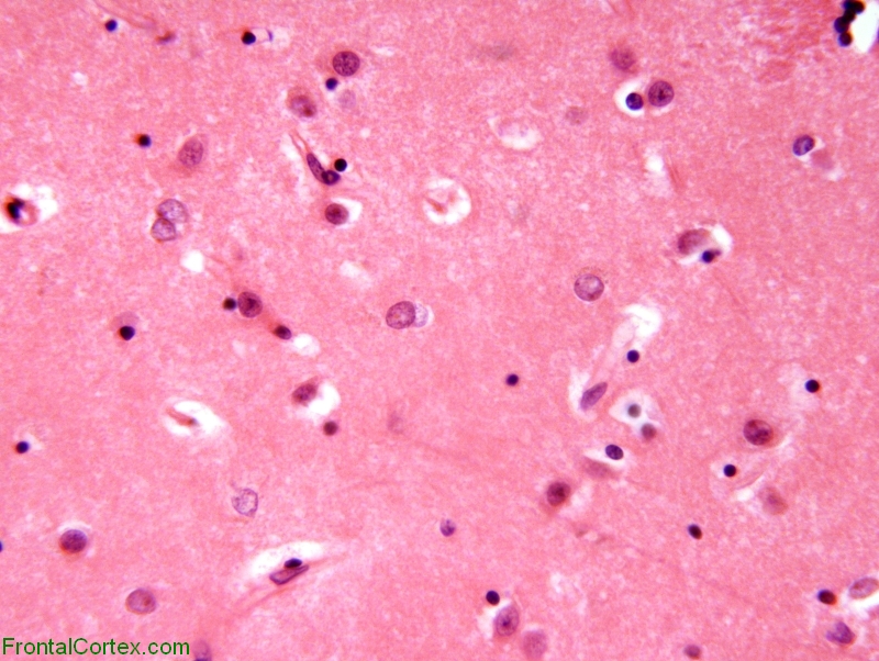 Alzheimer type 2 astrocytosis, H&E stain x 400