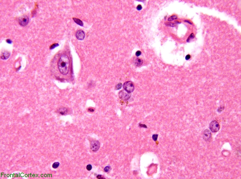 Alzheimer type 2 astrocytosis, H&E x 400 and