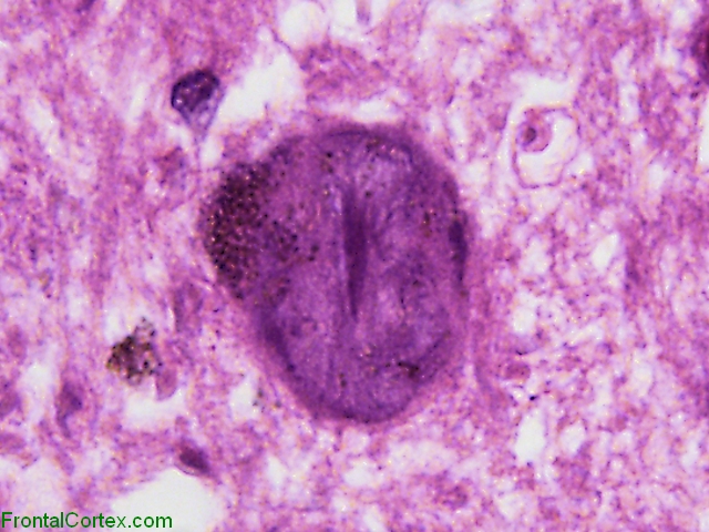 Alzheimer Disease NFTin Locus Ceruleus H&E